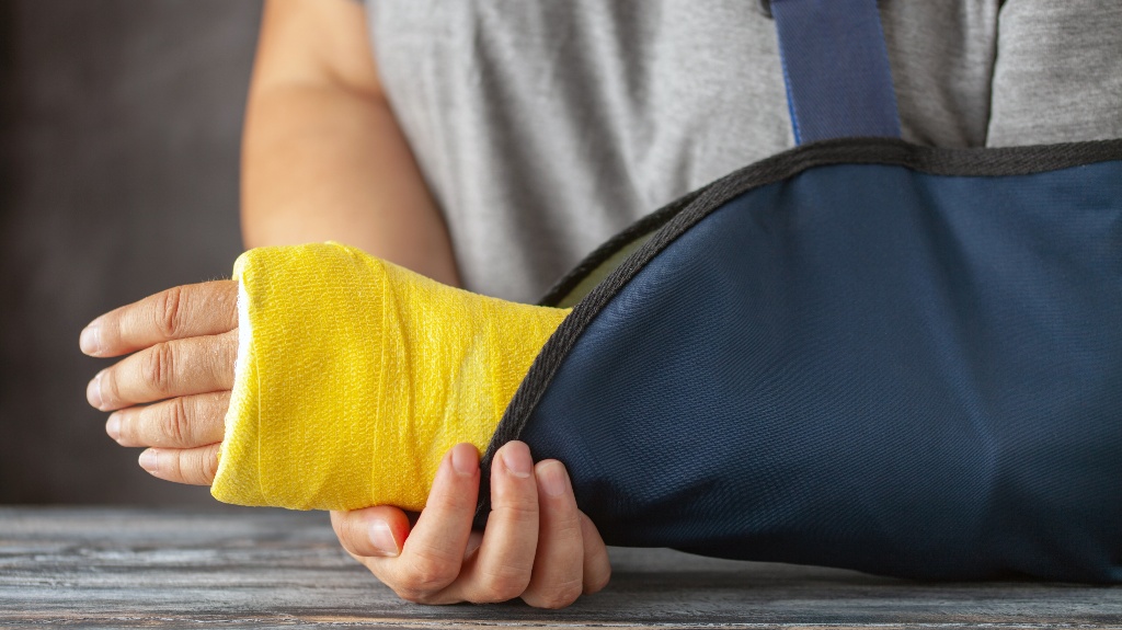 female with broken arm in a cast
